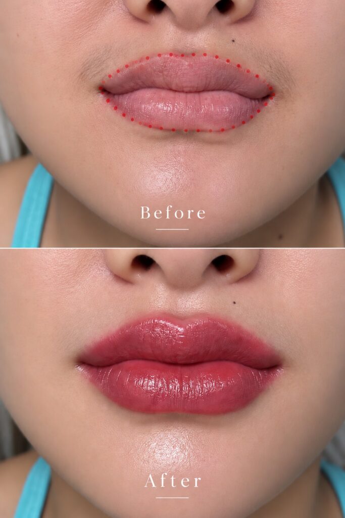 ก่อนและหลังสักปาก Lip Blush ทันทีหลังทำเสร็จ จากปากซีดสีไม่สม่ำเสมอเป็นชมพูโรส โดย TITIÉ Beauty Studio