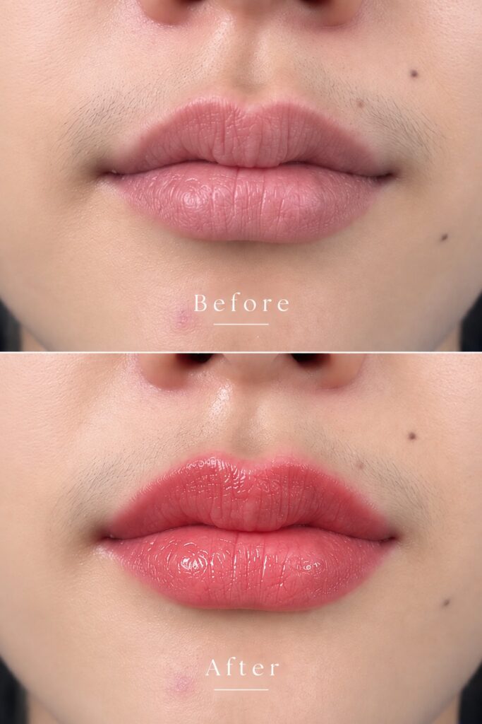 ก่อนและหลังสักปาก Lip Blush ทันทีหลังทำเสร็จ จากปากจางขอบไม่ชัดเป็นพีชอมชมพูธรรมชาติ โดย TITIÉ Beauty Studio